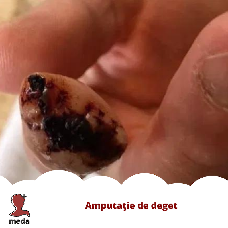 Tratarea ranilor - Tratamente la domiciliu - Pansamente - Cum procedez in cazul degetului amputat din imagine?