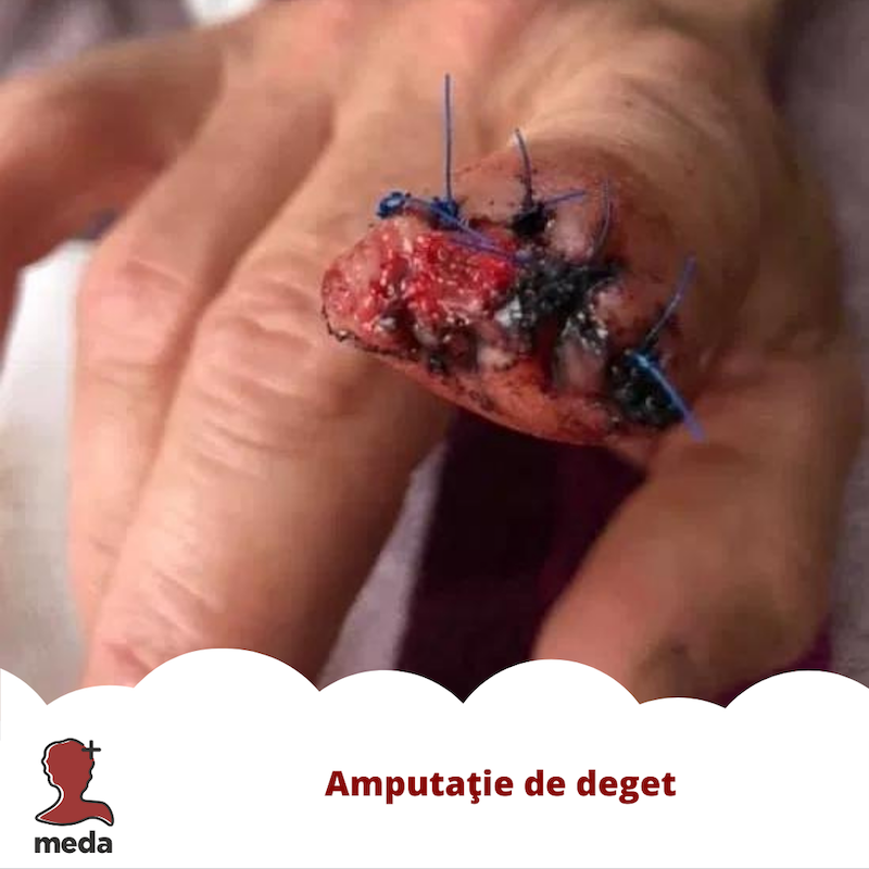 Tratarea ranilor - Tratamente la domiciliu - Pansamente - Cum procedez in cazul degetului amputat din imagine?