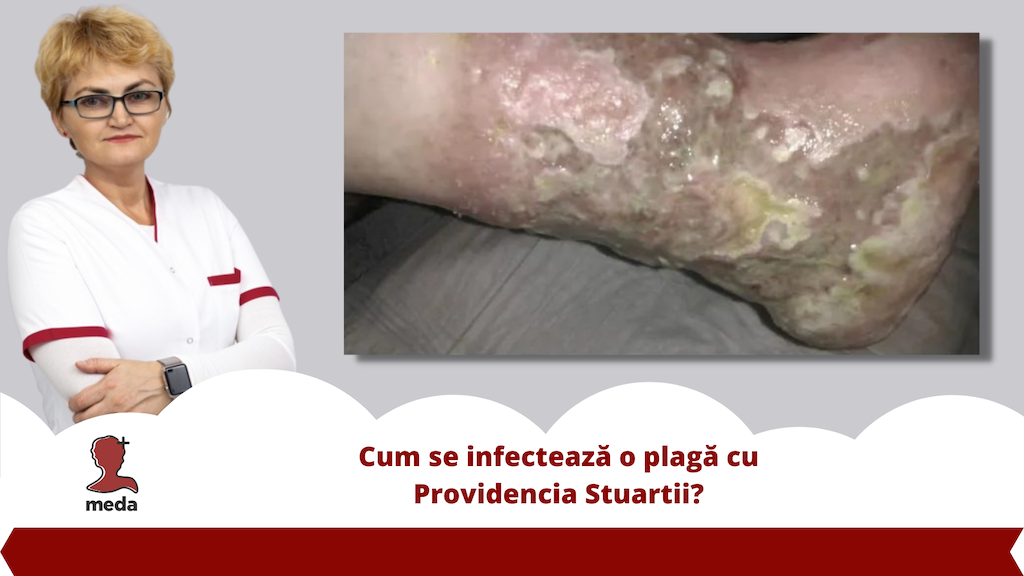 Cum se infecteaza o plaga cu 👉 Providencia Stuartii?