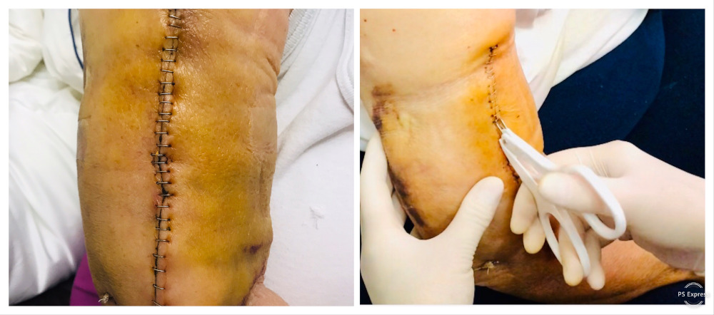 Cum-utilizez-DECAPSATORUL-chirurgical-