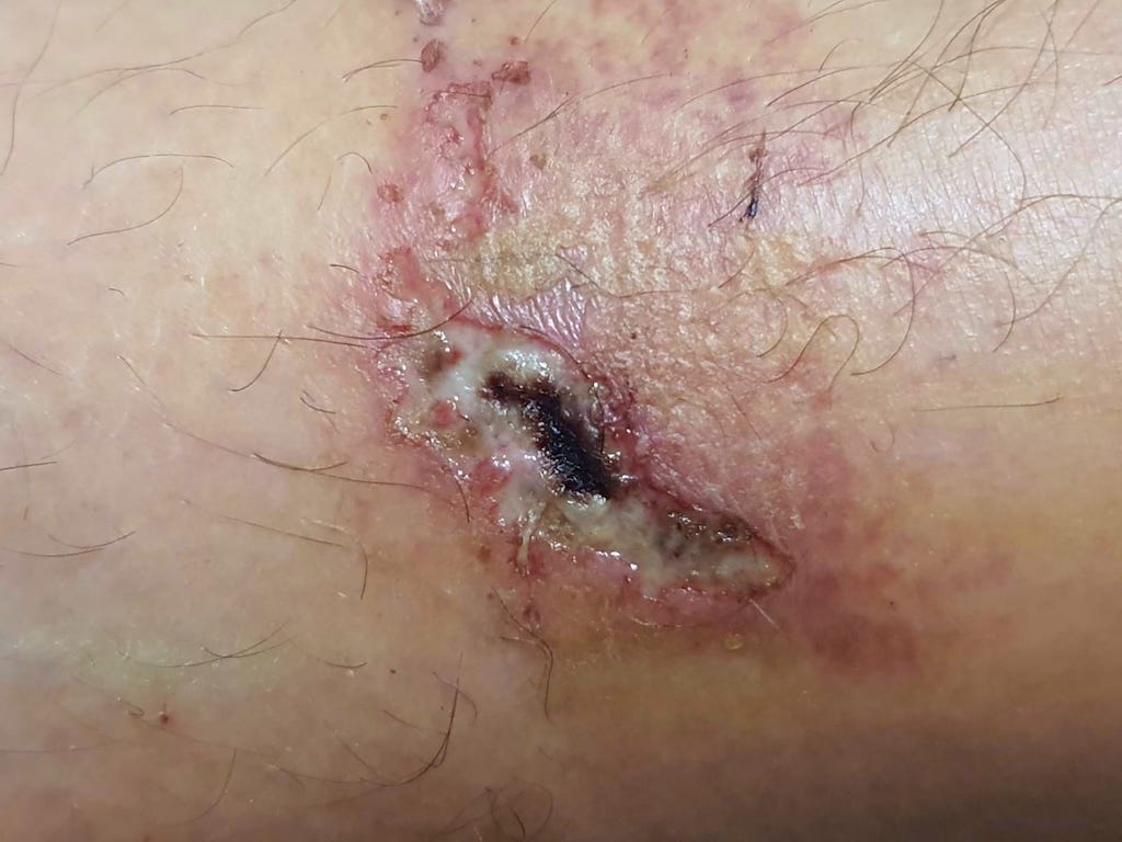 Tratamente la domiciliu - Pansamente - Tratarea ranilor 👉 plaga accidentala la mutatul mobilei 