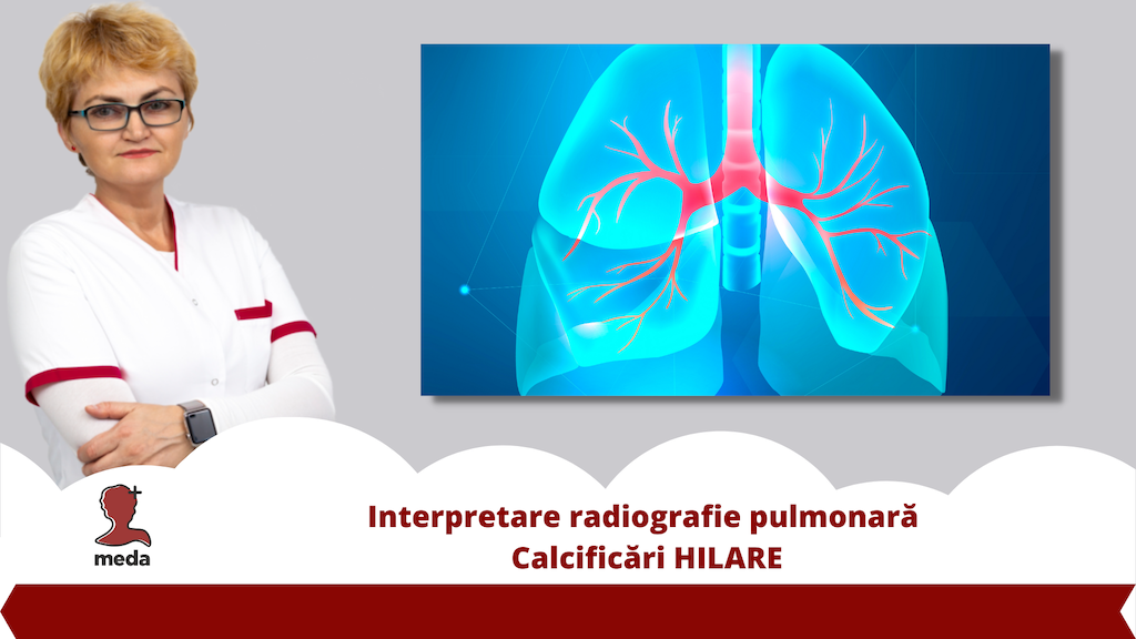 Interpretare radiografie pulmonara 👉 Calcificari HILARE