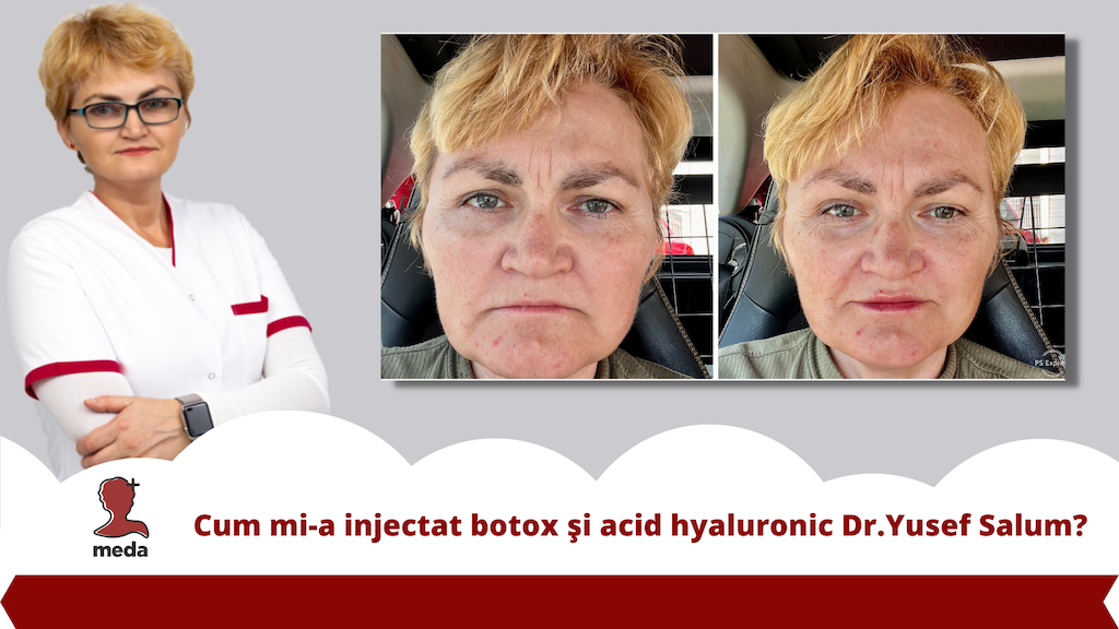 Cum mi-a injectat botox și acid hyaluronic Dr.Yusef Salum?