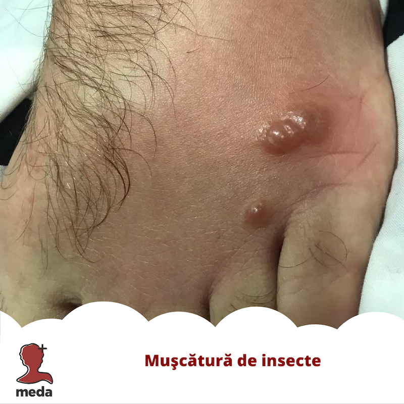 Muscatura insecta - Gel antihistaminic - Tratamente la domiciliu - Ce ar trebui sa fac 👉 in cazul muscaturii de insecte?