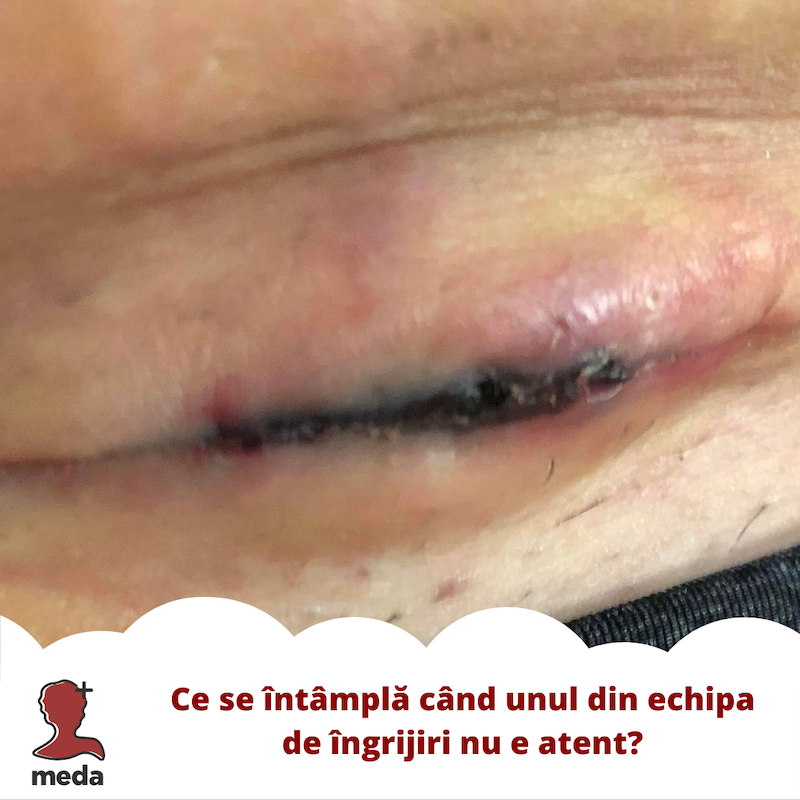 Strataderm vs Stratamed - Tratamente la domiciliu - Ce se intampla cand unul din echipa de ingrijiri nu e atent?