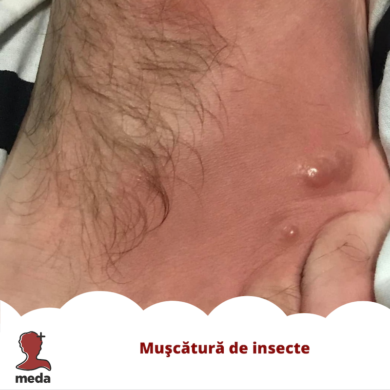 Muscatura insecta - Gel antihistaminic - Tratamente la domiciliu - Ce ar trebui sa fac 👉 in cazul muscaturii de insecte?