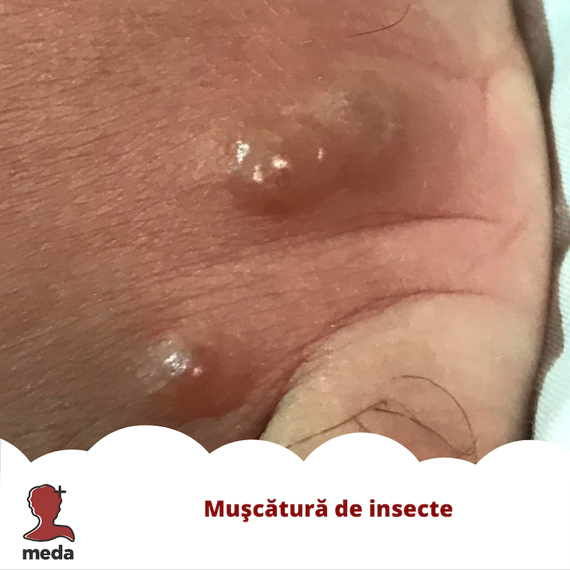 Muscatura insecta - Gel antihistaminic - Tratamente la domiciliu - Ce ar trebui sa fac 👉 in cazul muscaturii de insecte?