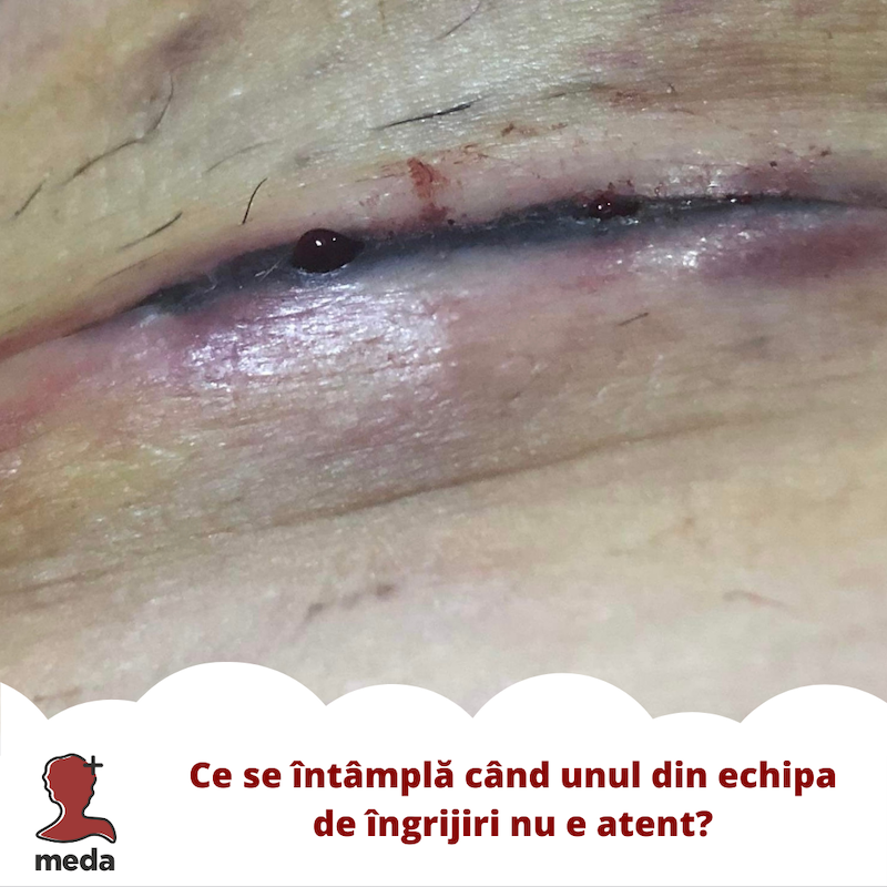 Strataderm vs Stratamed - Tratamente la domiciliu - Ce se intampla cand unul din echipa de ingrijiri nu e atent?