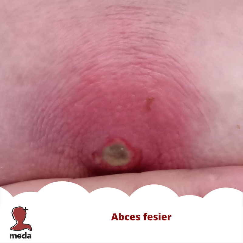 Abces fesier - URGENTA vs NON-URGENTA vesnica dilema a pacientilor