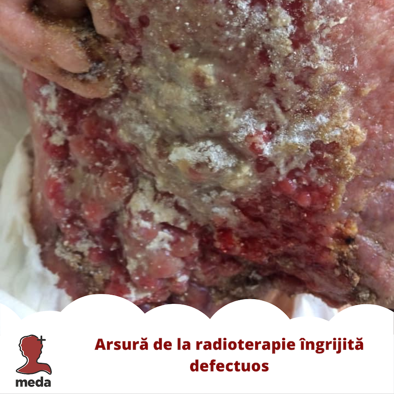 Arsură de la radioterapie îngrijită defectuos