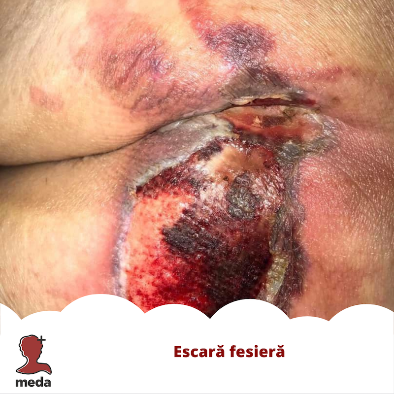 Escara fesiera - URGENTA vs NON-URGENTA vesnica dilema a pacientilor
