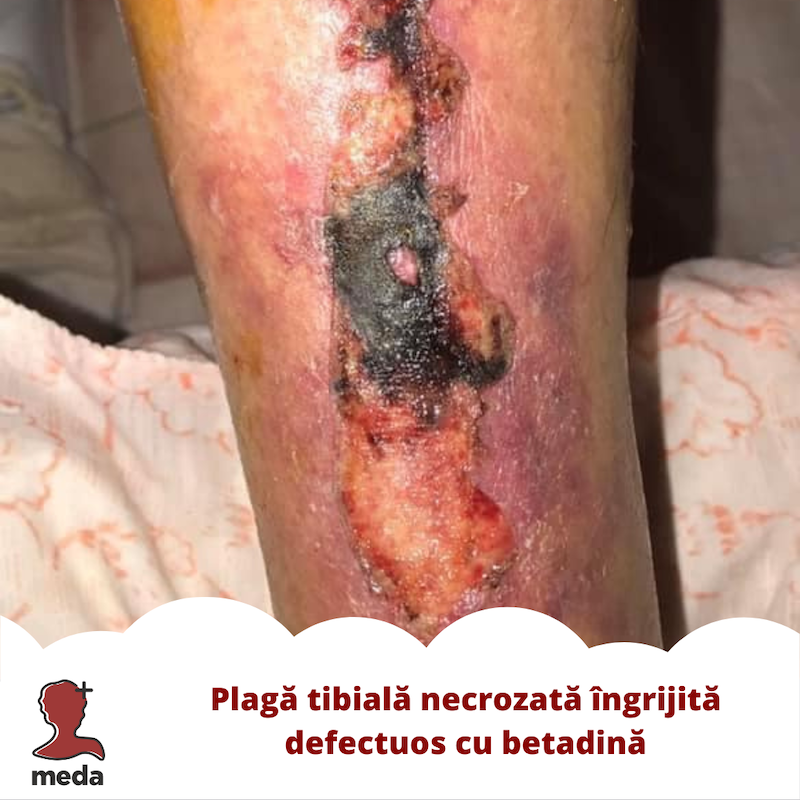 Plagă tibială necrozată îngrijită defectuos cu betadină