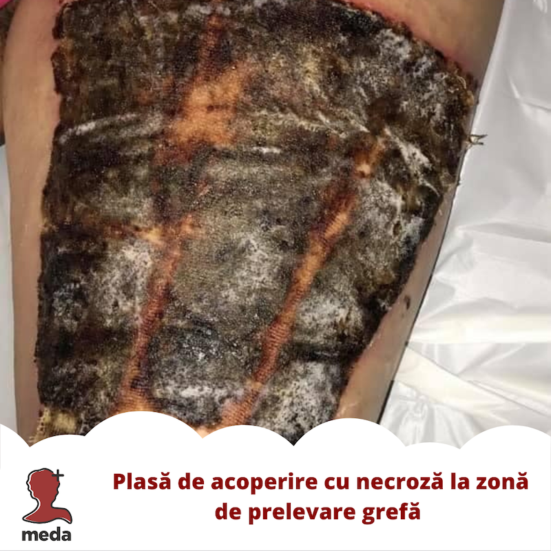 Escara fesiera - URGENTA vs NON-URGENTA vesnica dilema a pacientilor