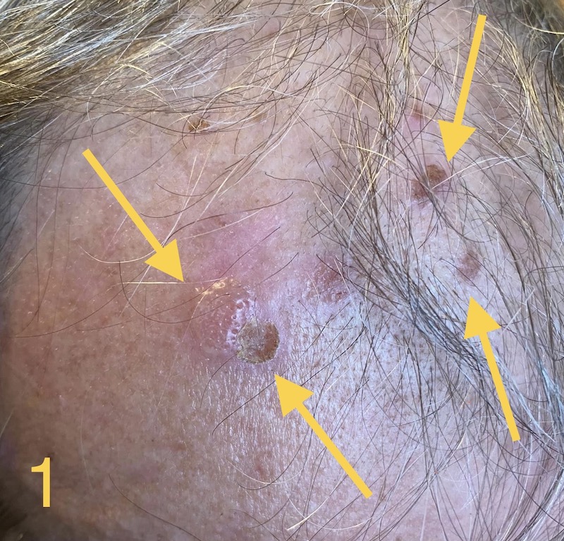 Tratarea ranilor - Tratamente la domiciliu - Tratarea ranilor 👉 Flictene pe pielea paroasa a capului