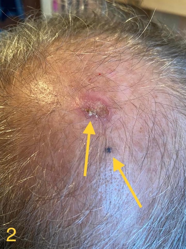 Tratarea ranilor - Tratamente la domiciliu - Tratarea ranilor 👉 Flictene pe pielea paroasa a capului