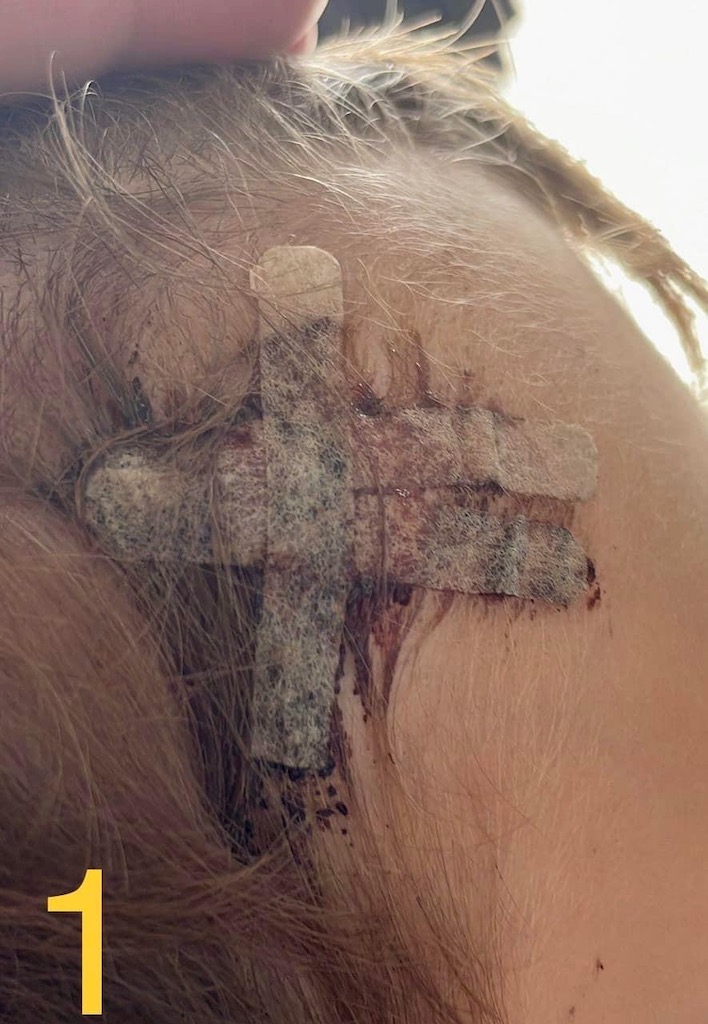 Cum vindeci o tăietură la frunte la un copil de 3 ani? - Poza articol