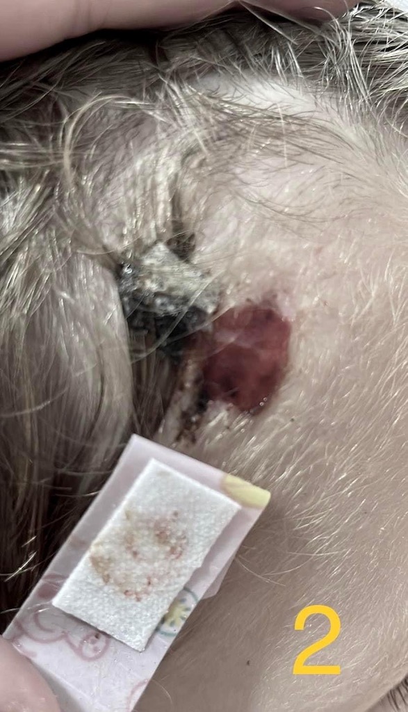 Cum vindeci o tăietură la frunte la un copil de 3 ani? - Poza articol