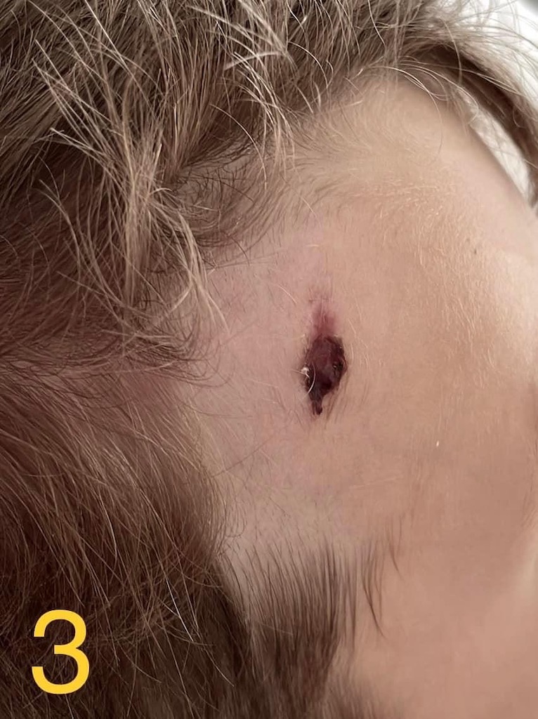 Cum vindeci o tăietură la frunte la un copil de 3 ani? - Poza articol