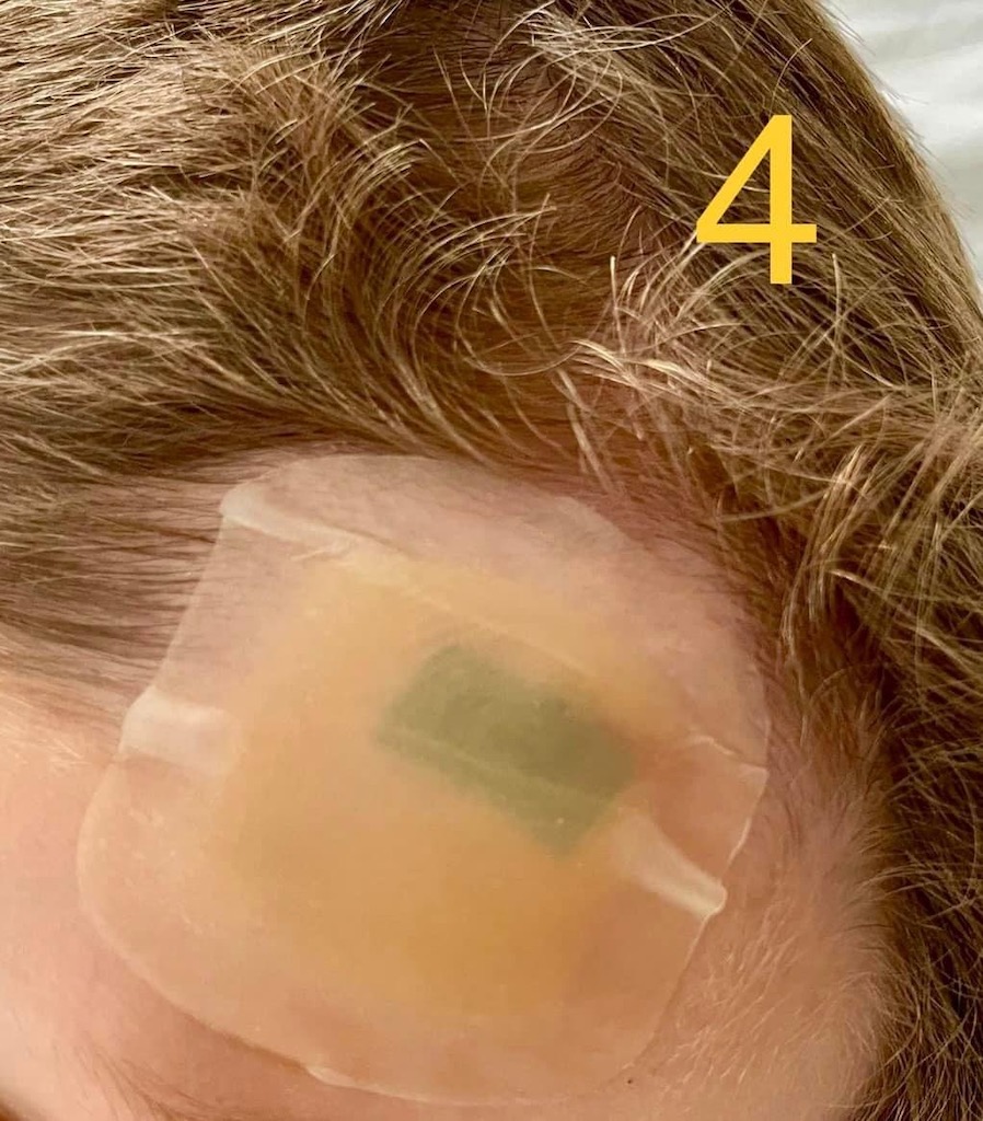 Cum vindeci o tăietură la frunte la un copil de 3 ani? - Poza articol