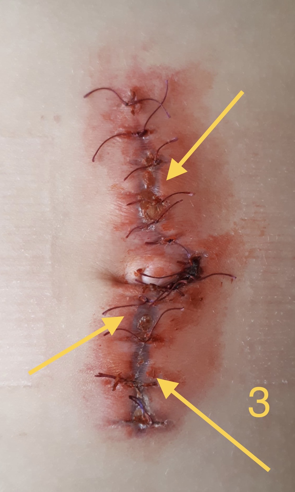 Tratarea ranilor - Tratamente la domiciliu - Cum poti complica o sutura care nu s-a vindecat per primam?