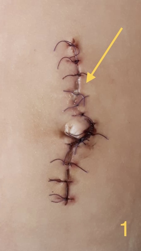 stick Tom Audreath Malawi Cum poti complica o sutura care nu s-a vindecat per primam?