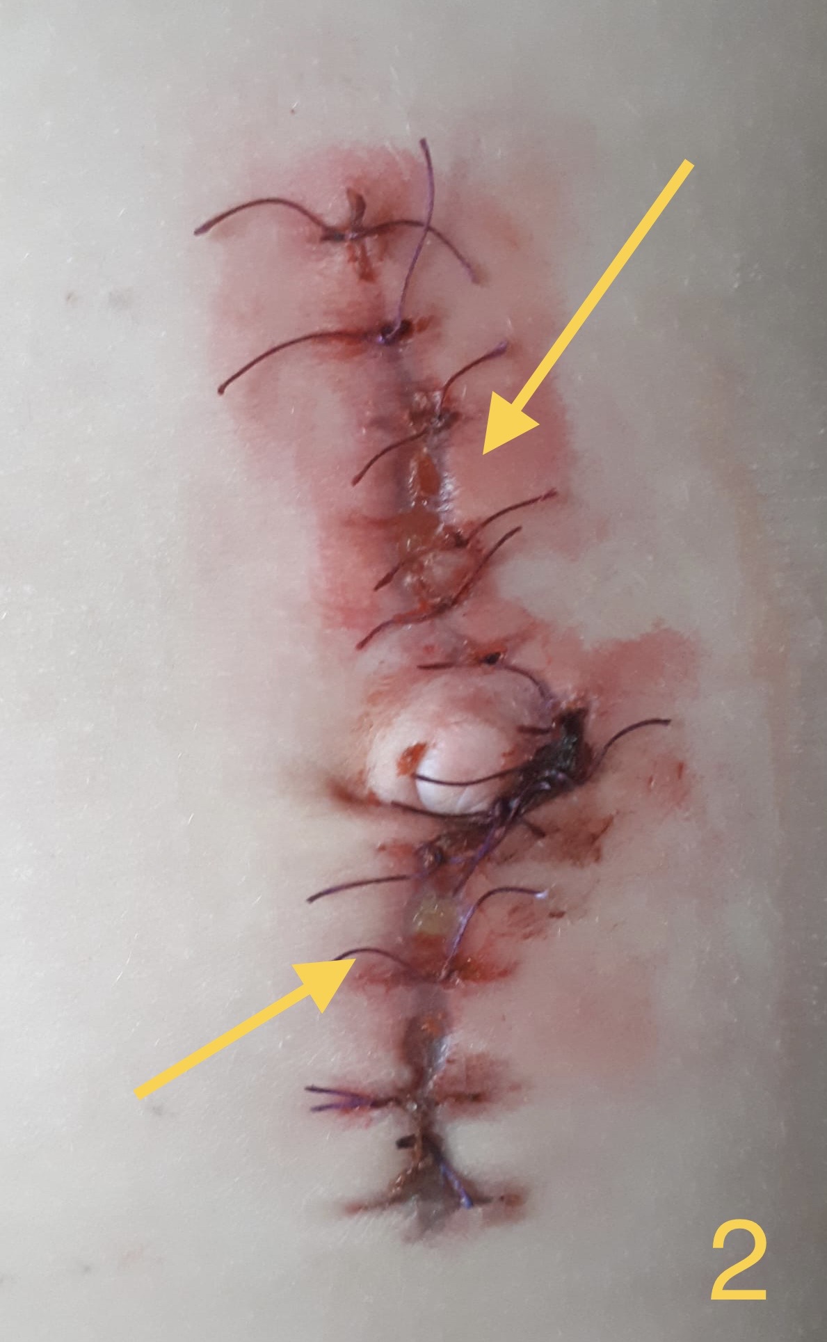 Tratarea ranilor - Tratamente la domiciliu - Cum poti complica o sutura care nu s-a vindecat per primam?