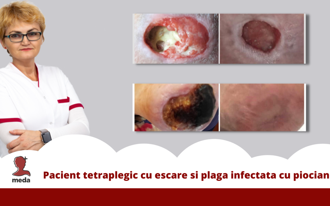 Webinar - Pacient tetraplegic cu escare si plaga infectata cu piocianic - Poza articol