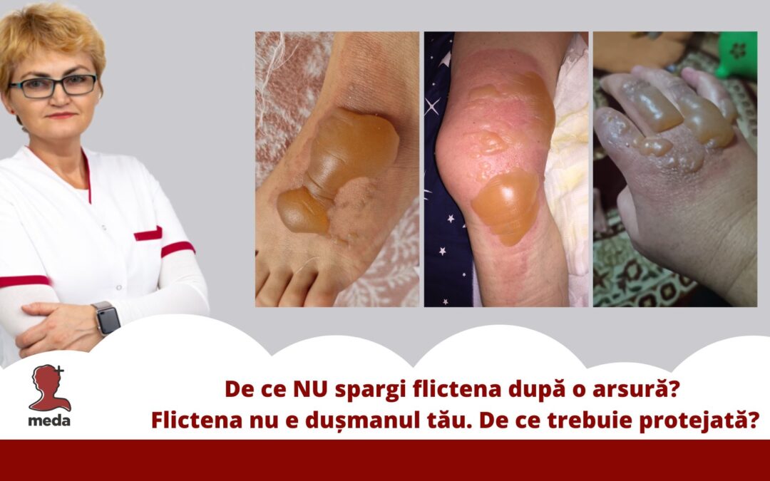 De ce NU trebuie să spargi flictena (bășica) după o arsură
