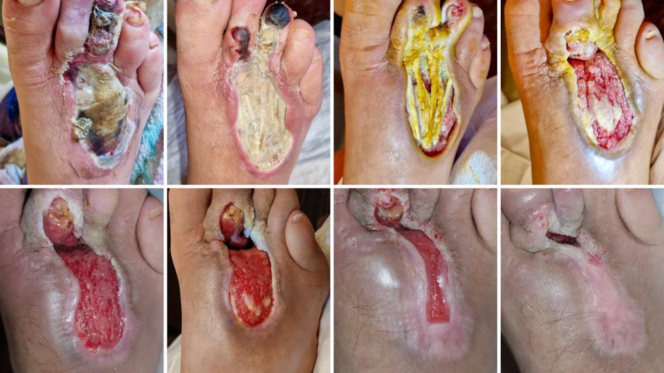 Evoluția unei plăgi severe la nivelul piciorului tratată prin îngrijire medicală la domiciliu.