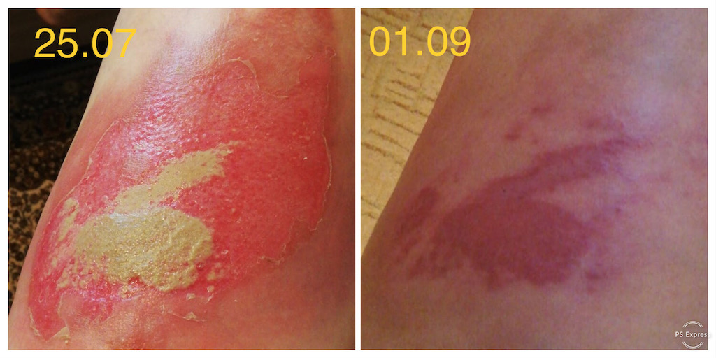 arsura lichid fierbinte tratament la domiciliu evolutia plagii 1