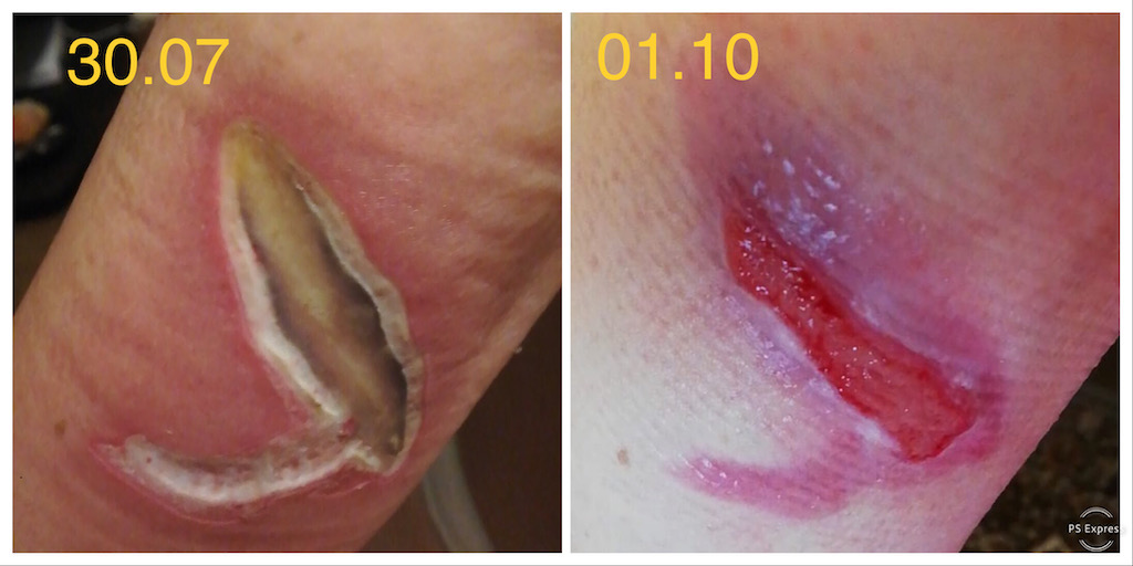 arsura lichid fierbinte tratament la domiciliu evolutia plagii 2