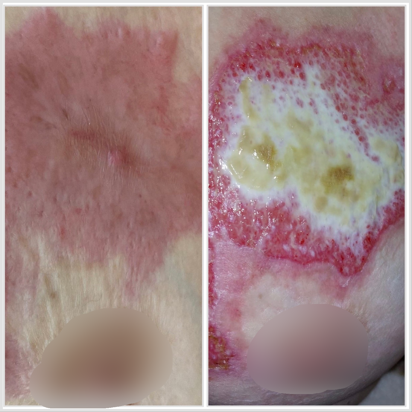 arsura severa san tratament domiciliu evolutie vindecare fara grefa