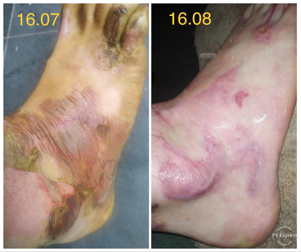arsura ulei incins picior tratament la domiciliu evolutie vindecare