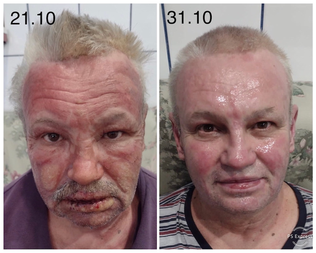 arsuri faciale tratate la domiciliu evoluția vindecării