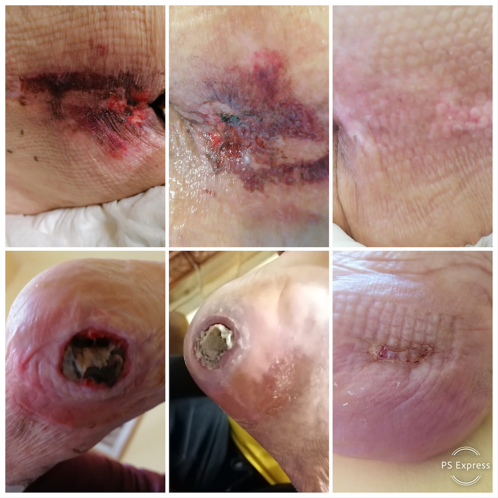 escara calcai tratament la domiciliu evolutie vindecare escara calcaneana pacient imobilizat