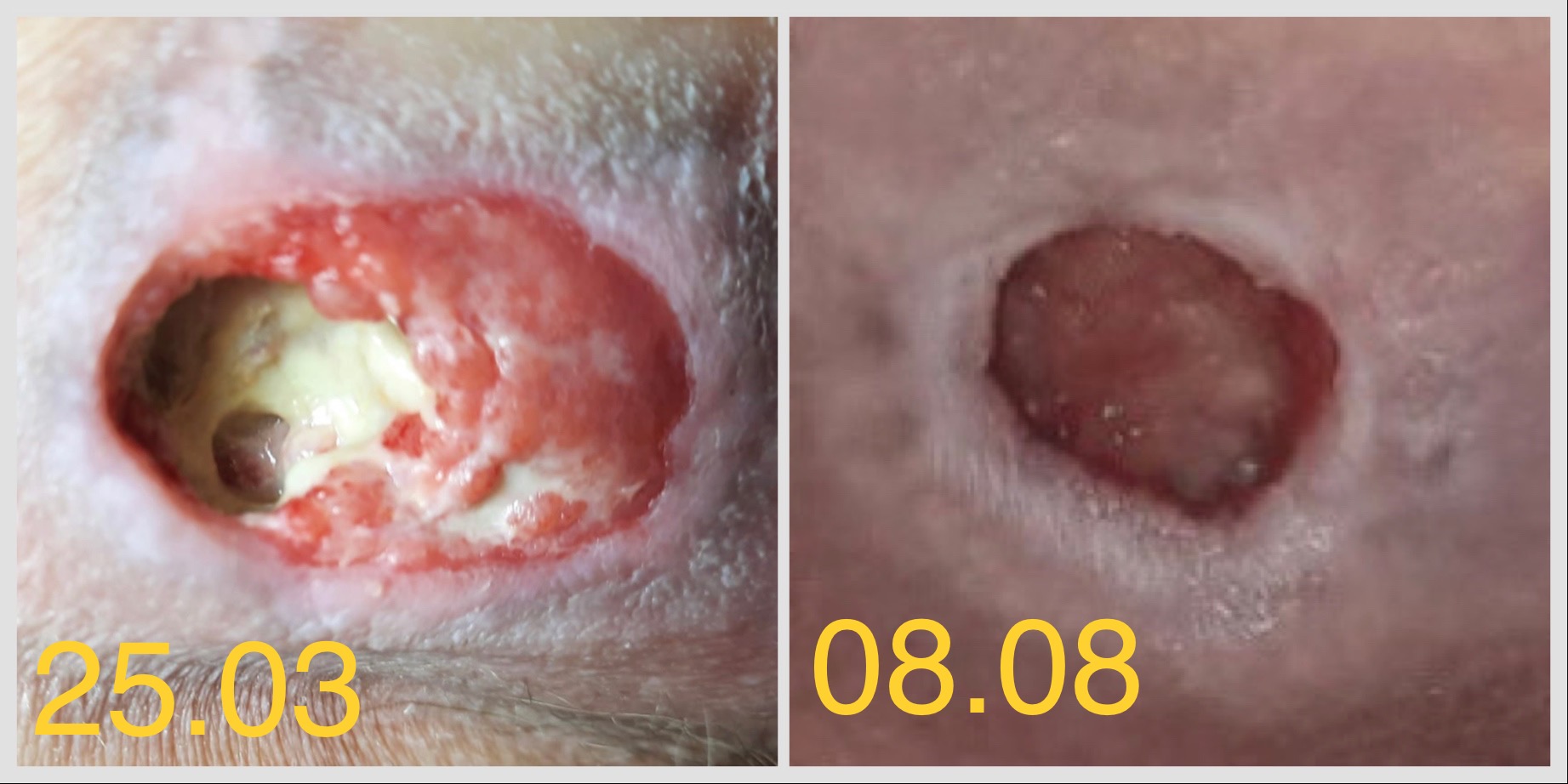 escara fesiera si escara calcaneana tratament la domiciliu evolutie vindecare escare dupa avc 1