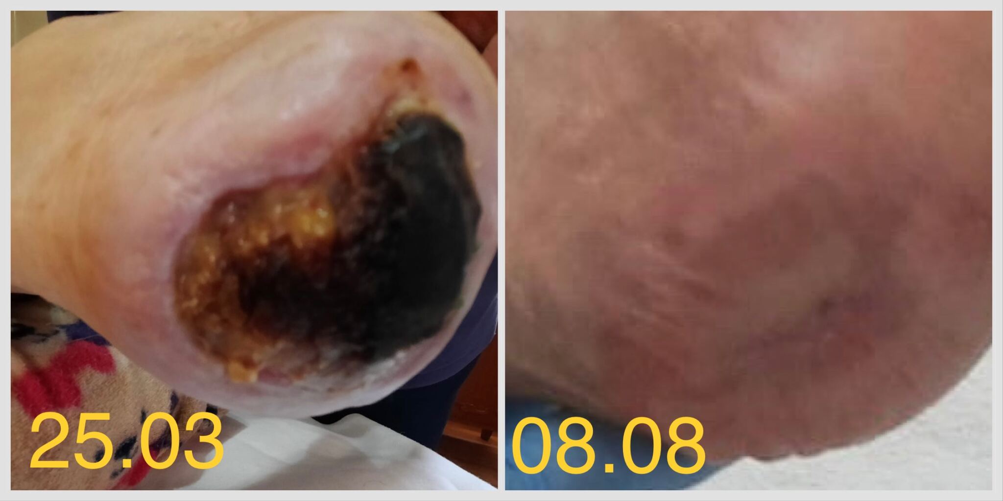 escara fesiera si escara calcaneana tratament la domiciliu evolutie vindecare escare dupa avc 2