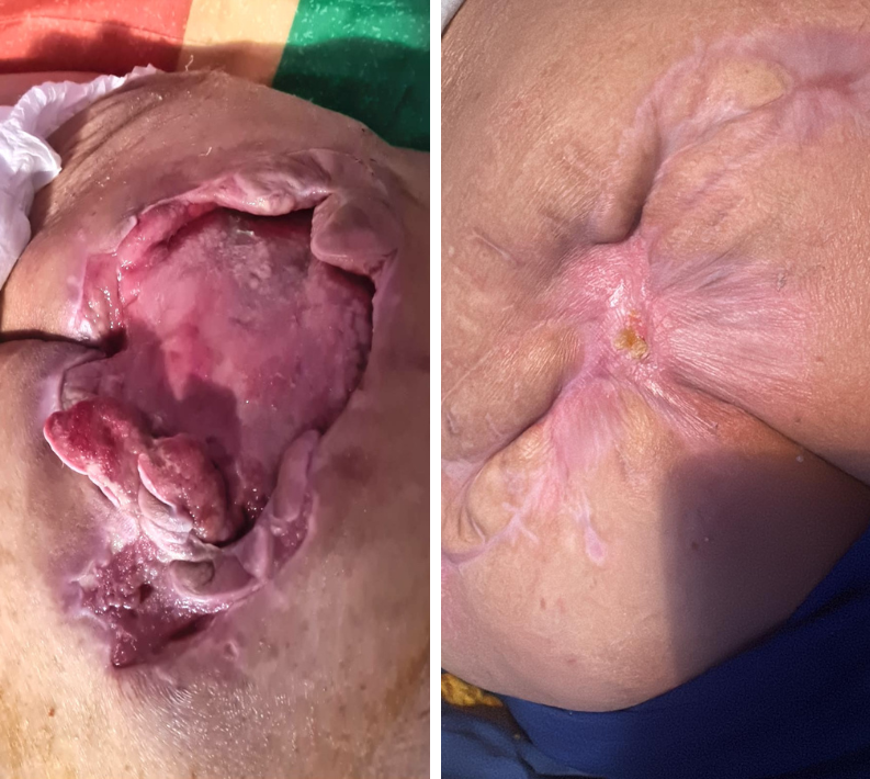 escara sacrala tratament la domiciliu escara profunda sacru evolutie vindecare escare pacient varstnic 1