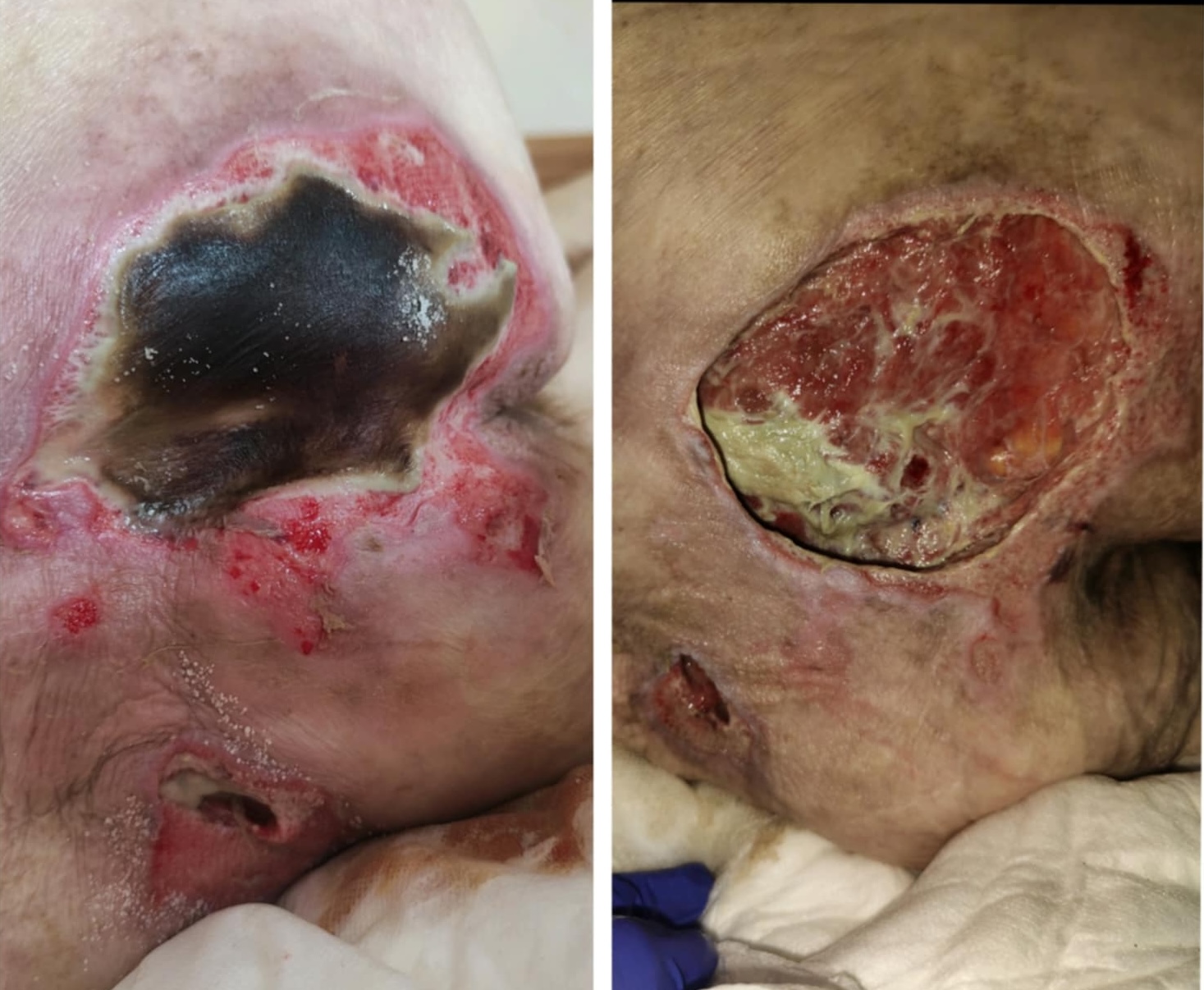 Evoluția unei escare severe tratate corect – plagă necrotică în curs de curățare și apariția țesutului de granulație după aplicarea protocoalelor de îngrijire a rănilor.