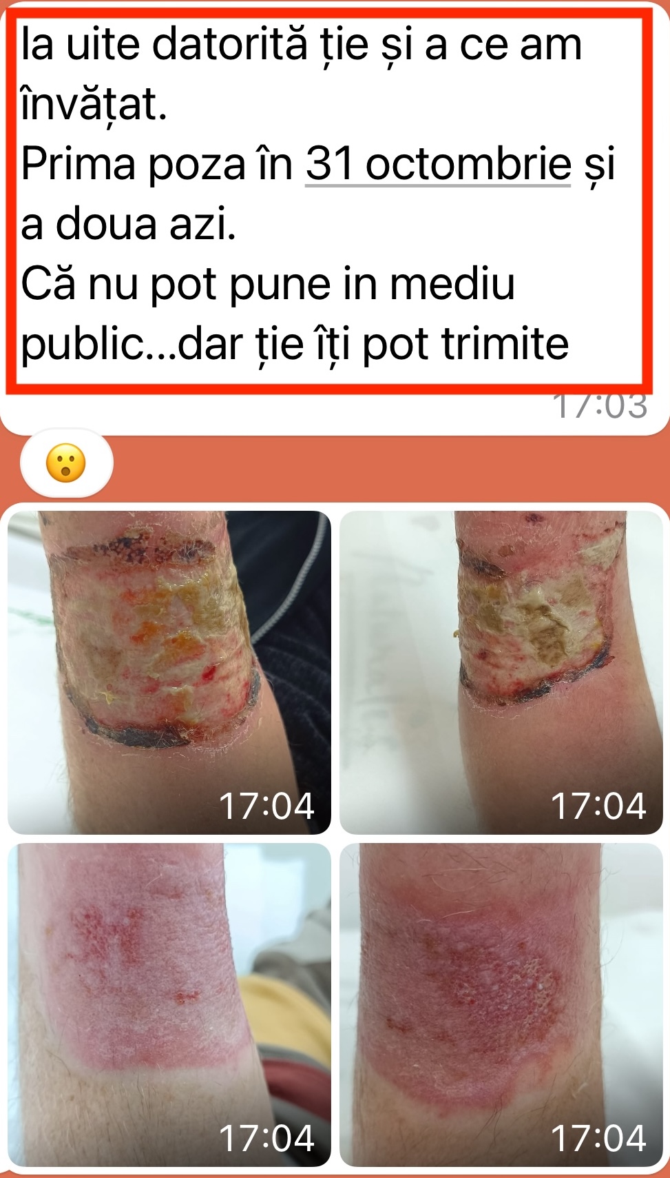 Evoluția unei escare severe tratate corect – plagă în fază de fibrină și inflamație urmată de reducerea inflamației și apariția țesutului de vindecare după aplicarea pansamentelor adaptate.
