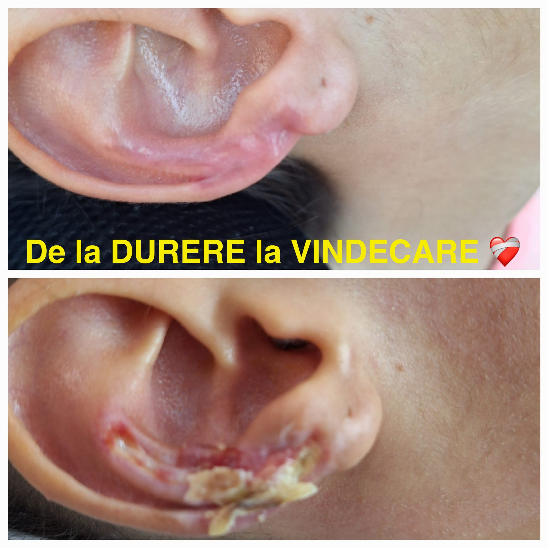 escara ureche copil tetraplegie spastica rana de presiune ureche tratament escare copii imobilizati