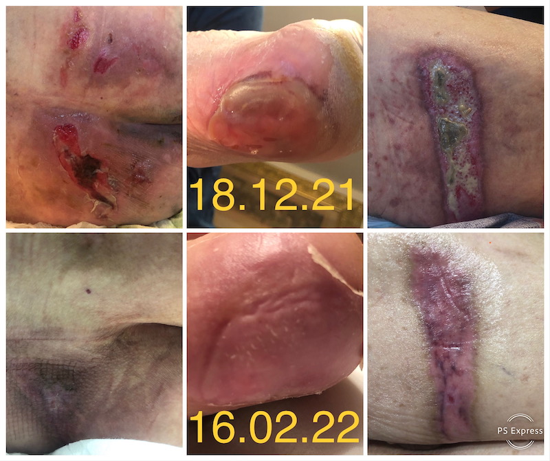 escare dupa imobilizare tratament la domiciliu evolutie vindecare escara calcai pacient traumatizat