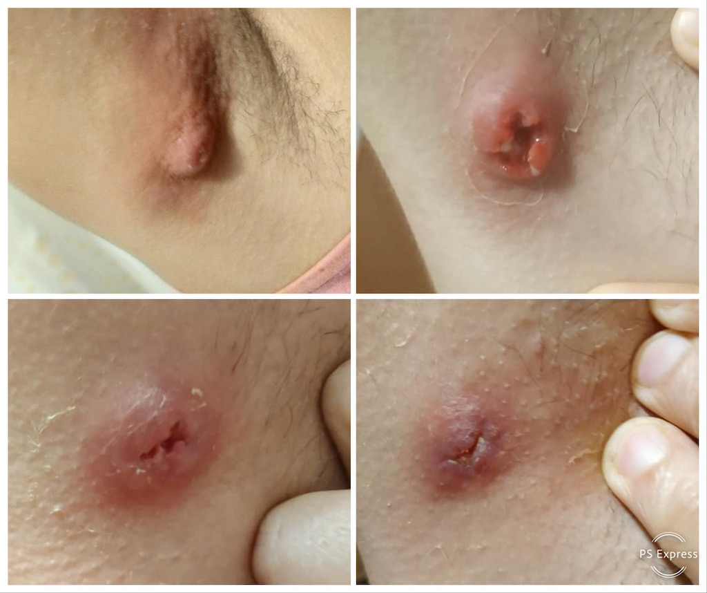 furuncul tratament domiciliu evolutie vindecare infectie cutanata