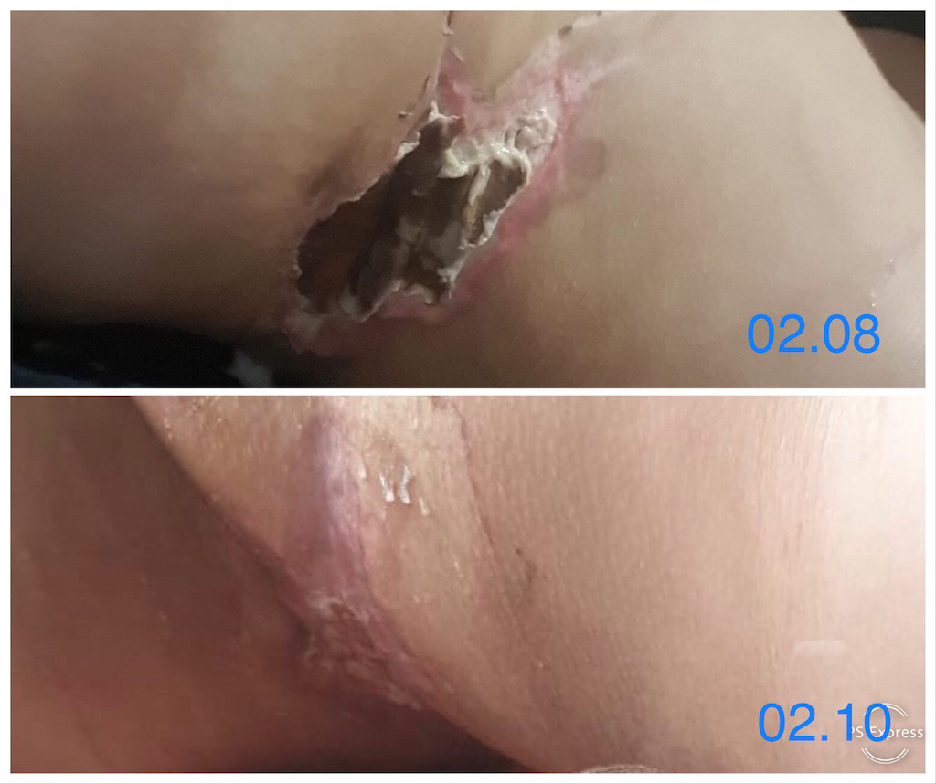 necroza dupa operatie plastica tratament rana necrozata evolutie vindecare 1