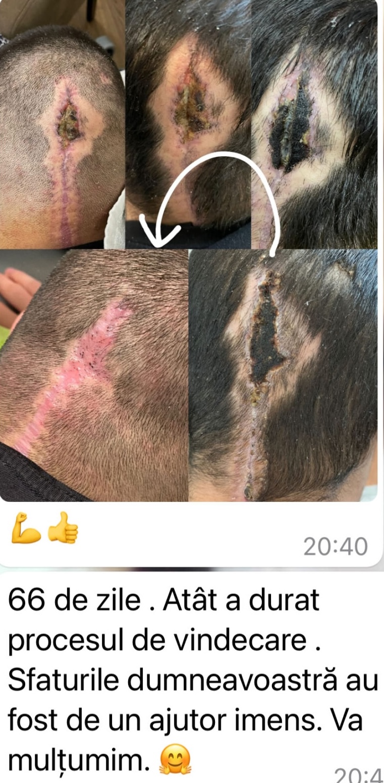 necroză plagă sutură după intervenție neurochirurgicală evoluție vindecare1