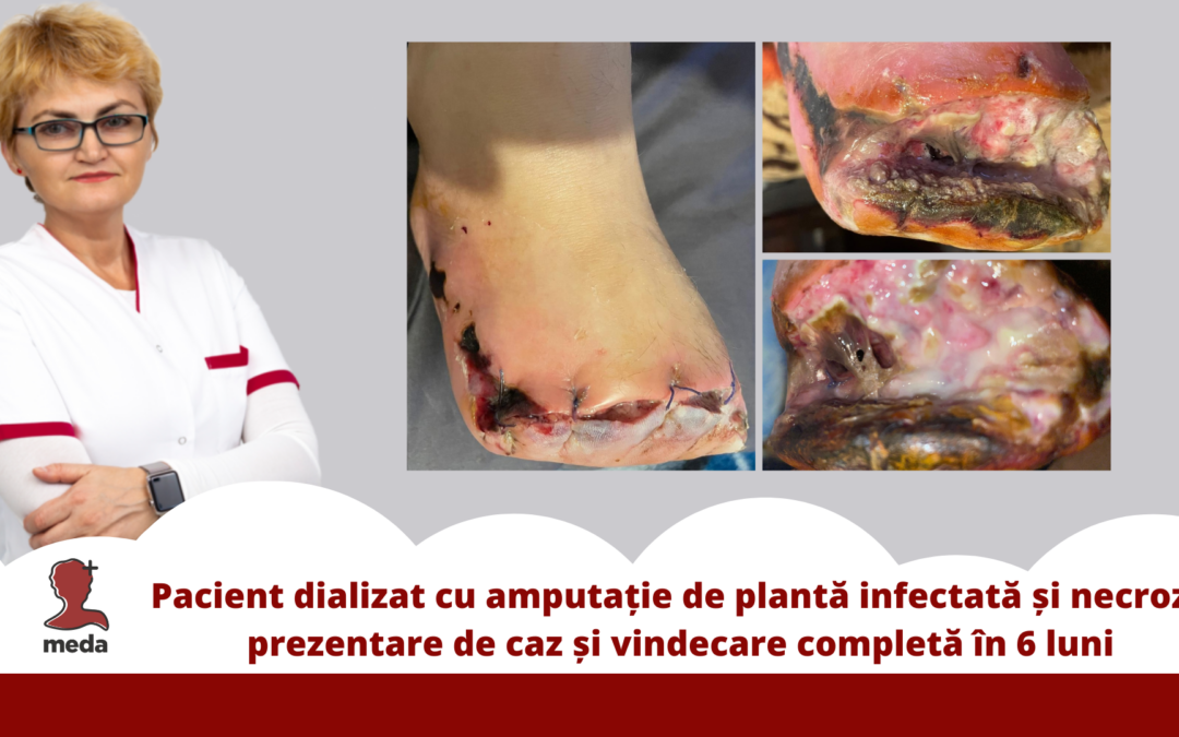 Pacient dializat cu amputație de plantă infectată și necroză — prezentare de caz și vindecare completă în 6 luni