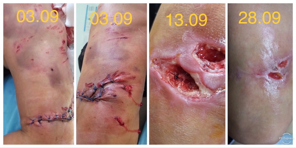 plagă mușcătură de câine evoluția vindecării tratament domiciliu