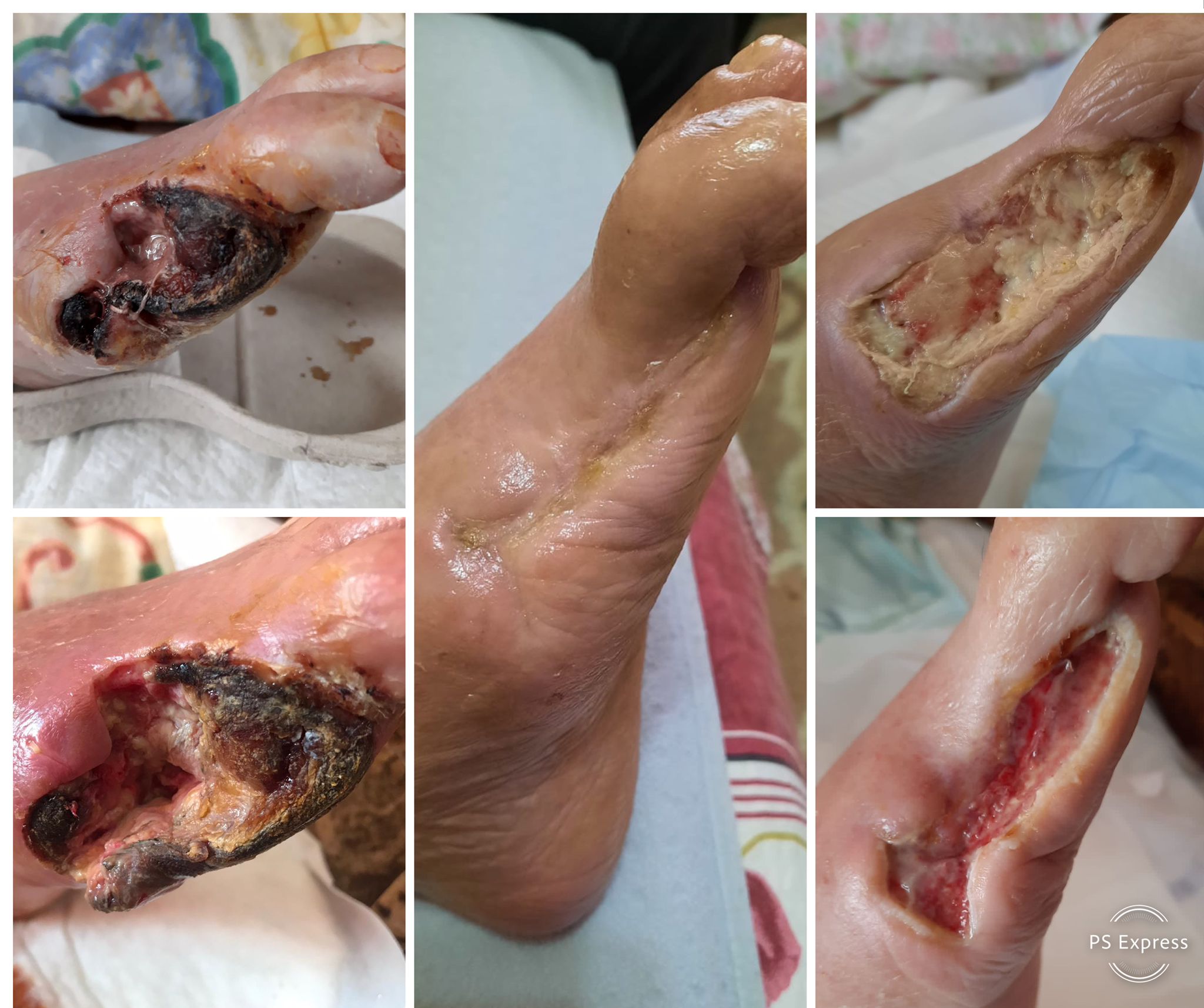 plagă necrozată haluce evoluția vindecării tratament domiciliu