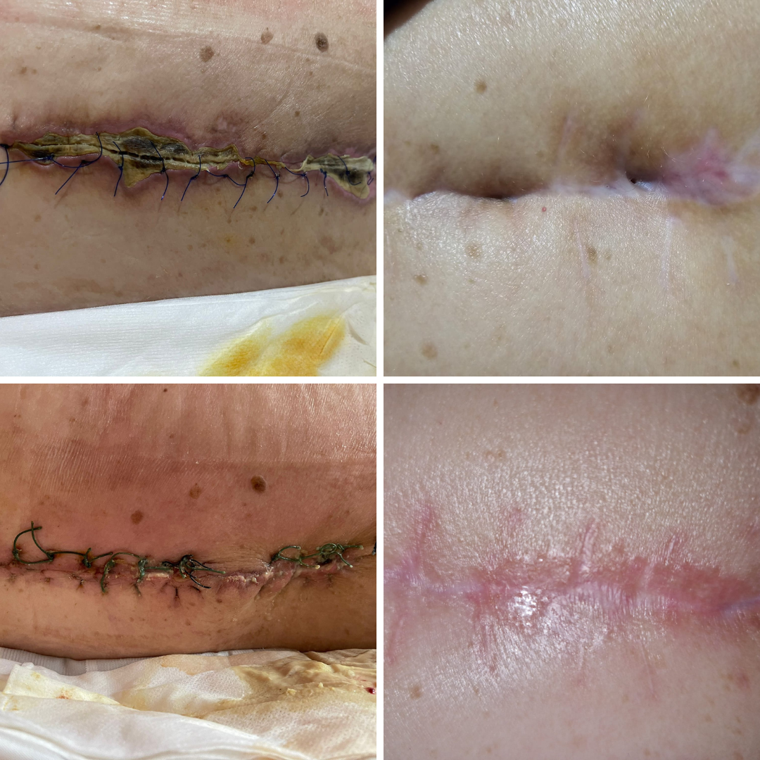 rana dupa operatie coloana vertebrala necroza sutura postoperatorie vindecare plaga neurochirurgie 1