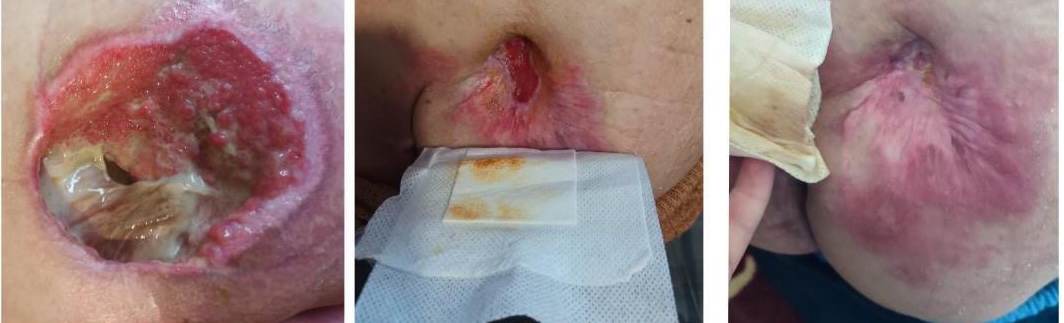 Evoluția unei plăgi severe tratate corect: de la plagă infectată la vindecare progresivă prin îngrijire medicală adecvată.